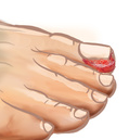 MR Podiatry in-grown toenail 